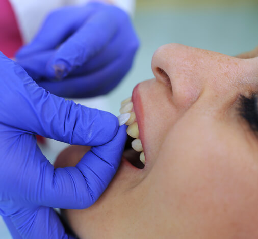 Sealants and Fillings: How They Work Together